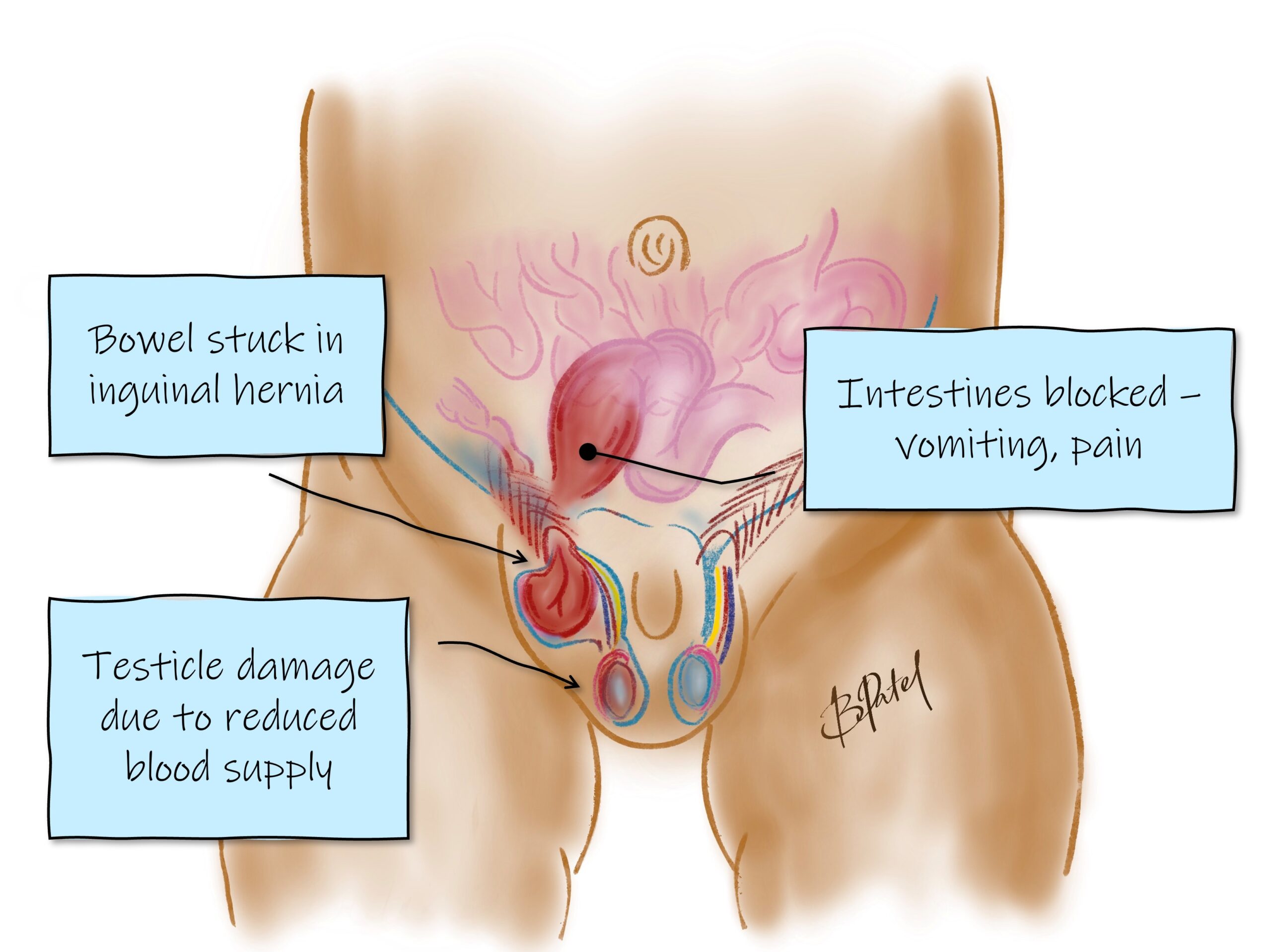 Testicular Hernia